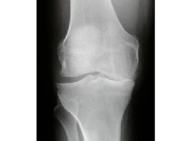 Diagnostic de l'arthrose de l'articulation du genou