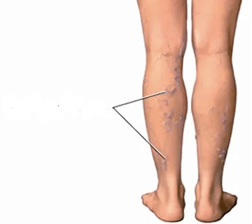 Les conséquences de l'arthrose du genou