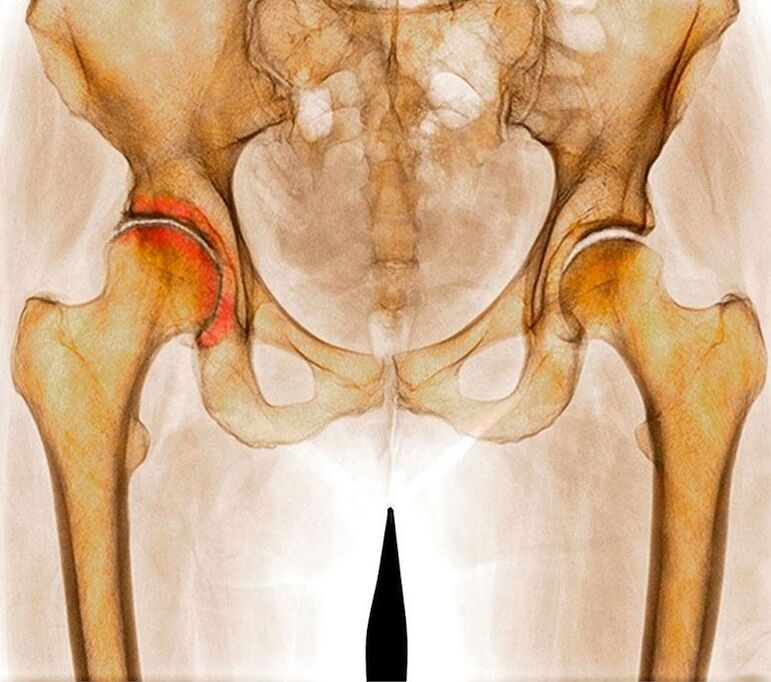 Ostéoarthrite articulaire de la hanche