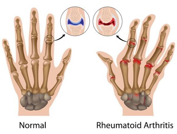 Doigts sans pathologie et polyarthrite rhumatoïde
