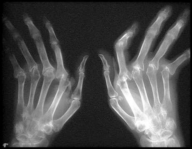 X-Ray des mains touchées par l'arthrose