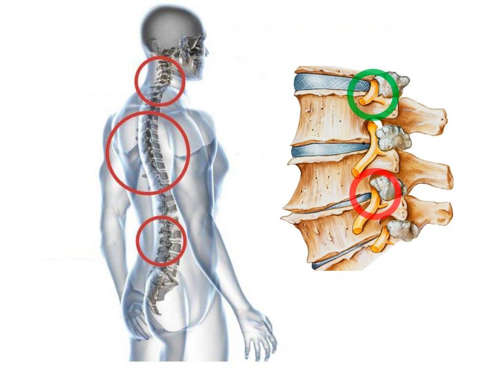 Comment voyez-vous l'ostéochondrose cervicale des vertèbres