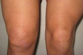 Inflammation de l'articulation du genou avec arthrite et arthrose.
