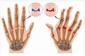 différences entre l'arthrite et l'arthrose des mains