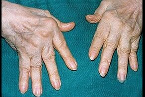 symptômes de l'arthrite des doigts