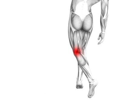 Arthrose de l'articulation du genou.