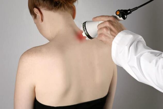 La thérapie au laser est utilisée pour lutter contre les maux de dos dans la région de l'omoplate. 