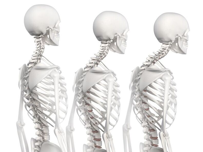 Degrés de développement de l'ostéochondrose thoracique à l'aide de l'exemple d'un modèle squelettique. 