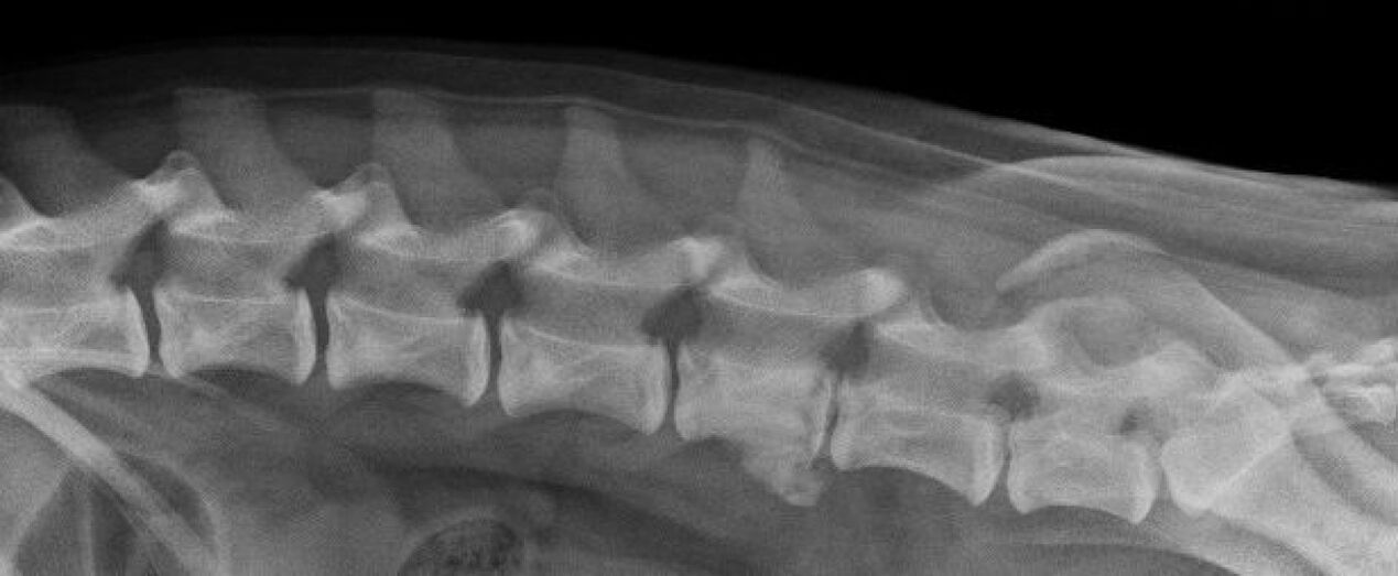 Manifestations d'ostéochondrose de la colonne thoracique sur une radiographie. 