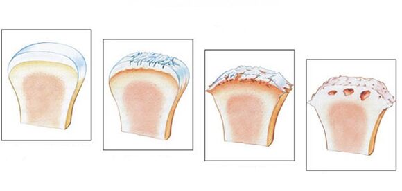 Articulation de la cheville saine et degré de développement de l'arthrose. 